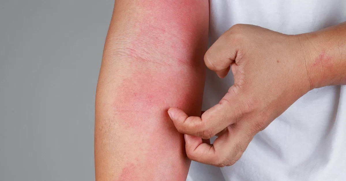 Dermatology skin care eczema psoriasis treatment Klinik Bustari Kuching