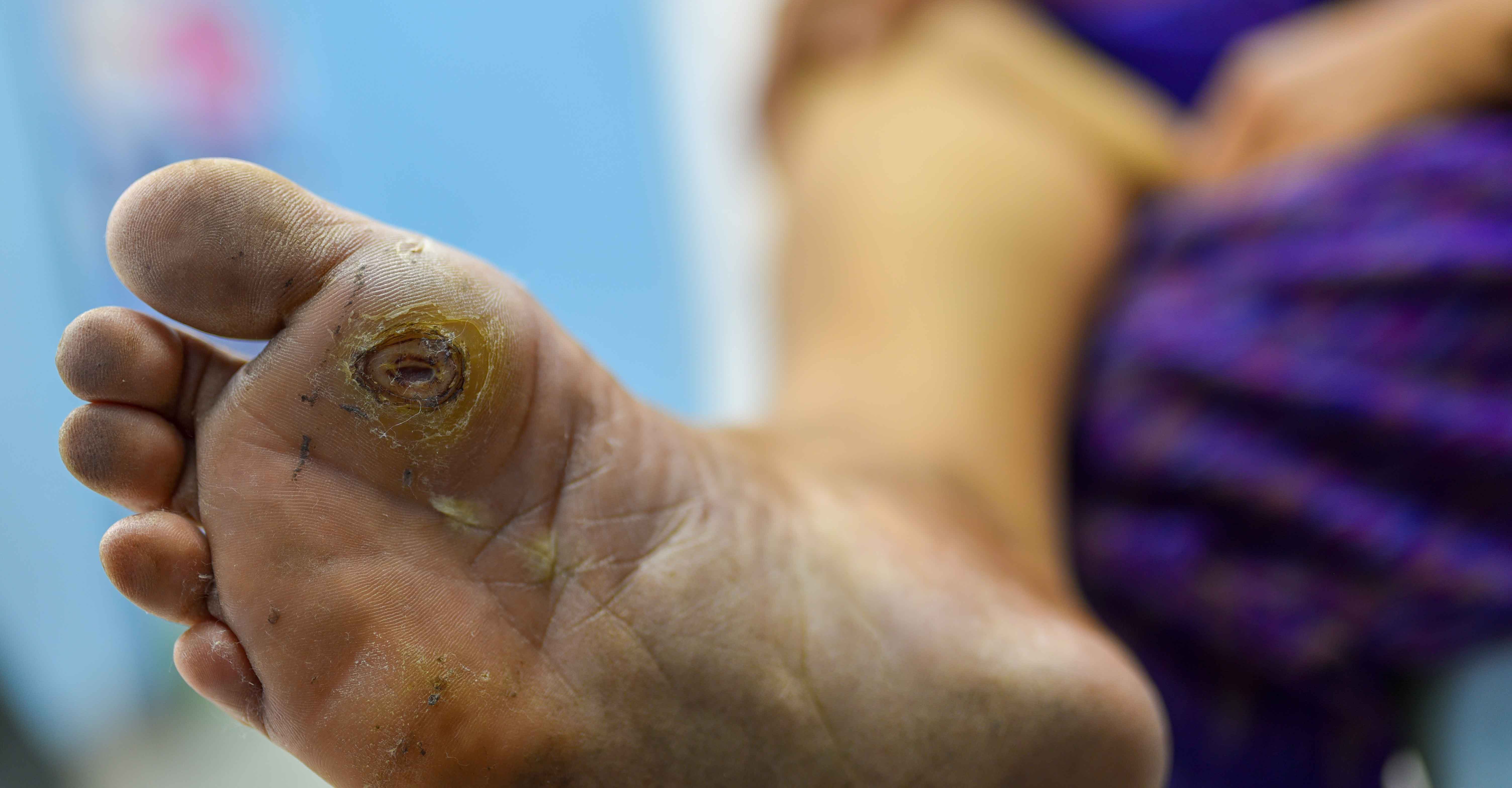 Diabetic Wound