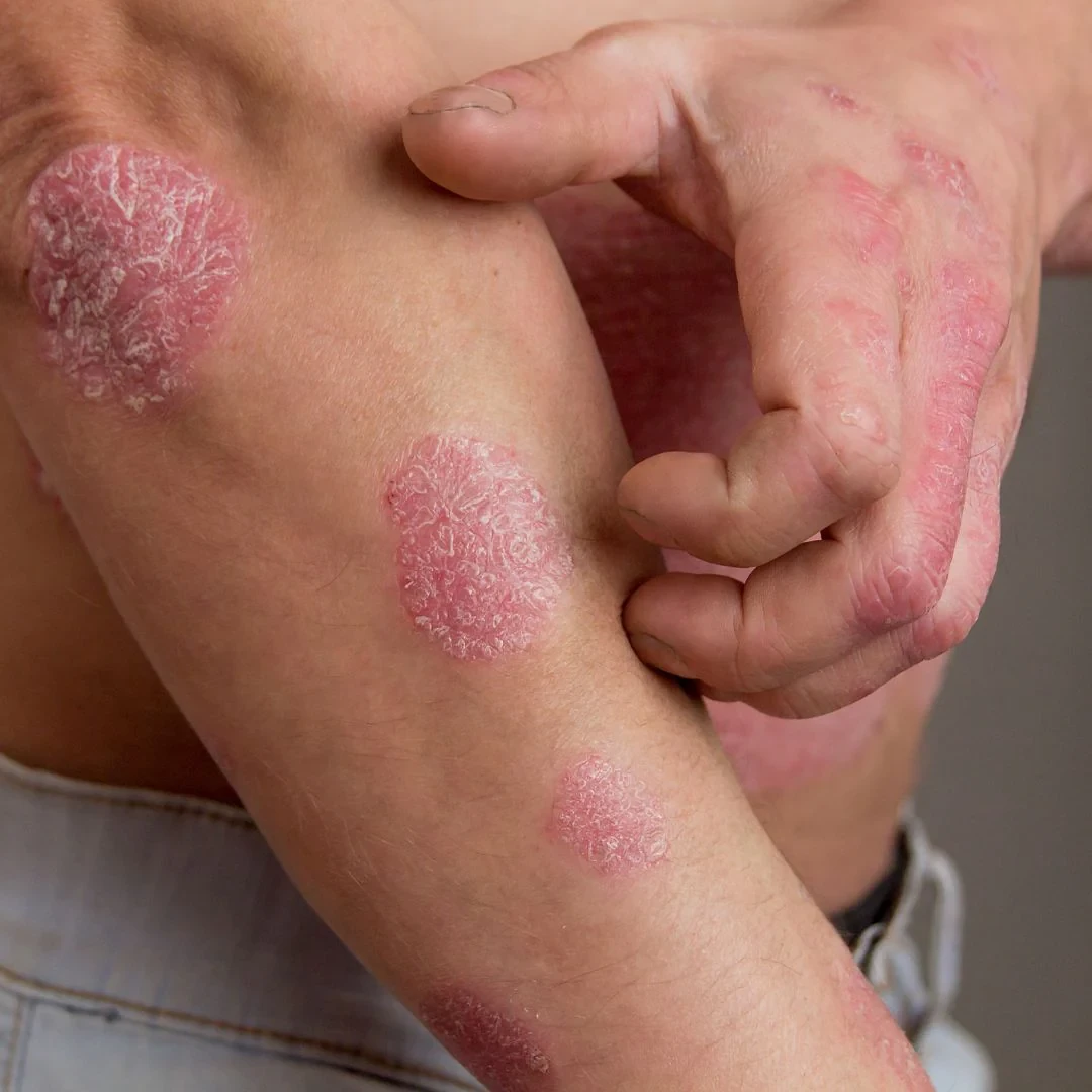 Psoriasis functional medicine treatment Kuching